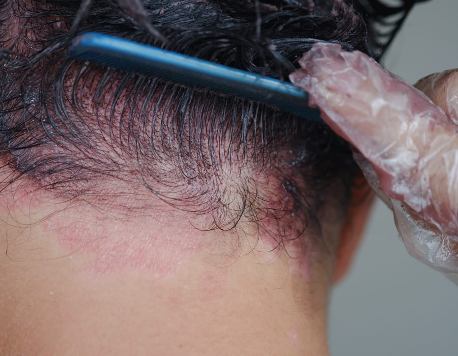 Allergies peau et cheveux produits chimiques Allergies peau et cheveux produits chimiques